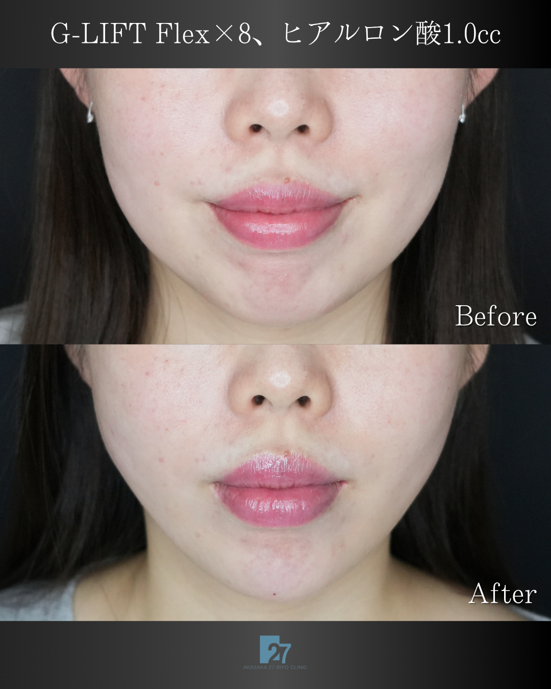 G-LIFT Flex × 8本、ヒアルロン酸1.0cc