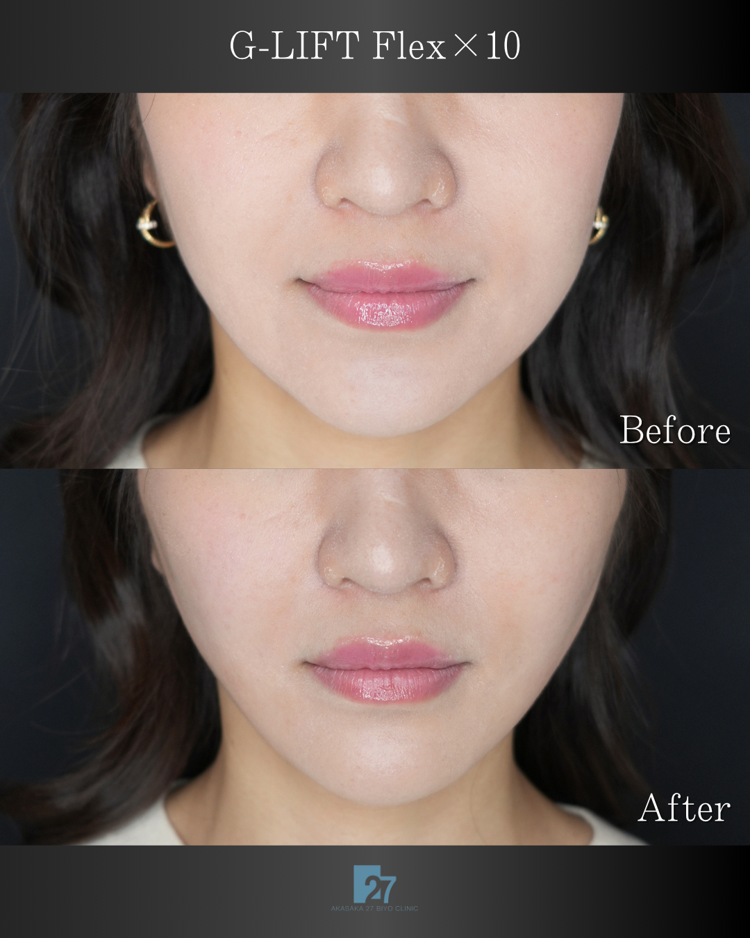 G-LIFT Flex × 10本